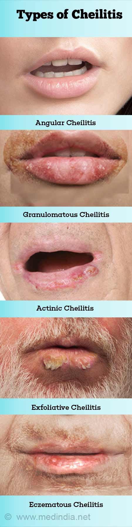 Angular cheilitis: Treatment, causes, and contagiousness